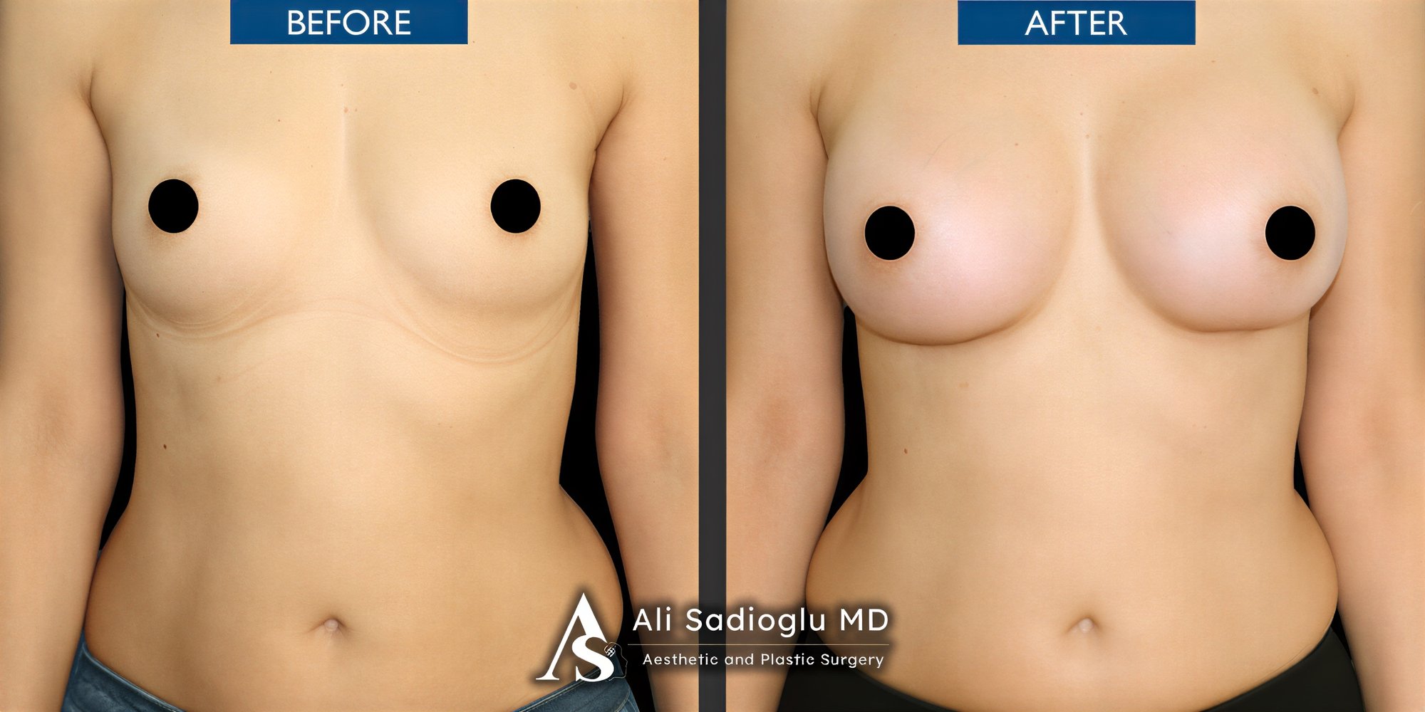 Resultados antes y después de mastopexia con implantes redondos en Dr. Safa Manav Clinic