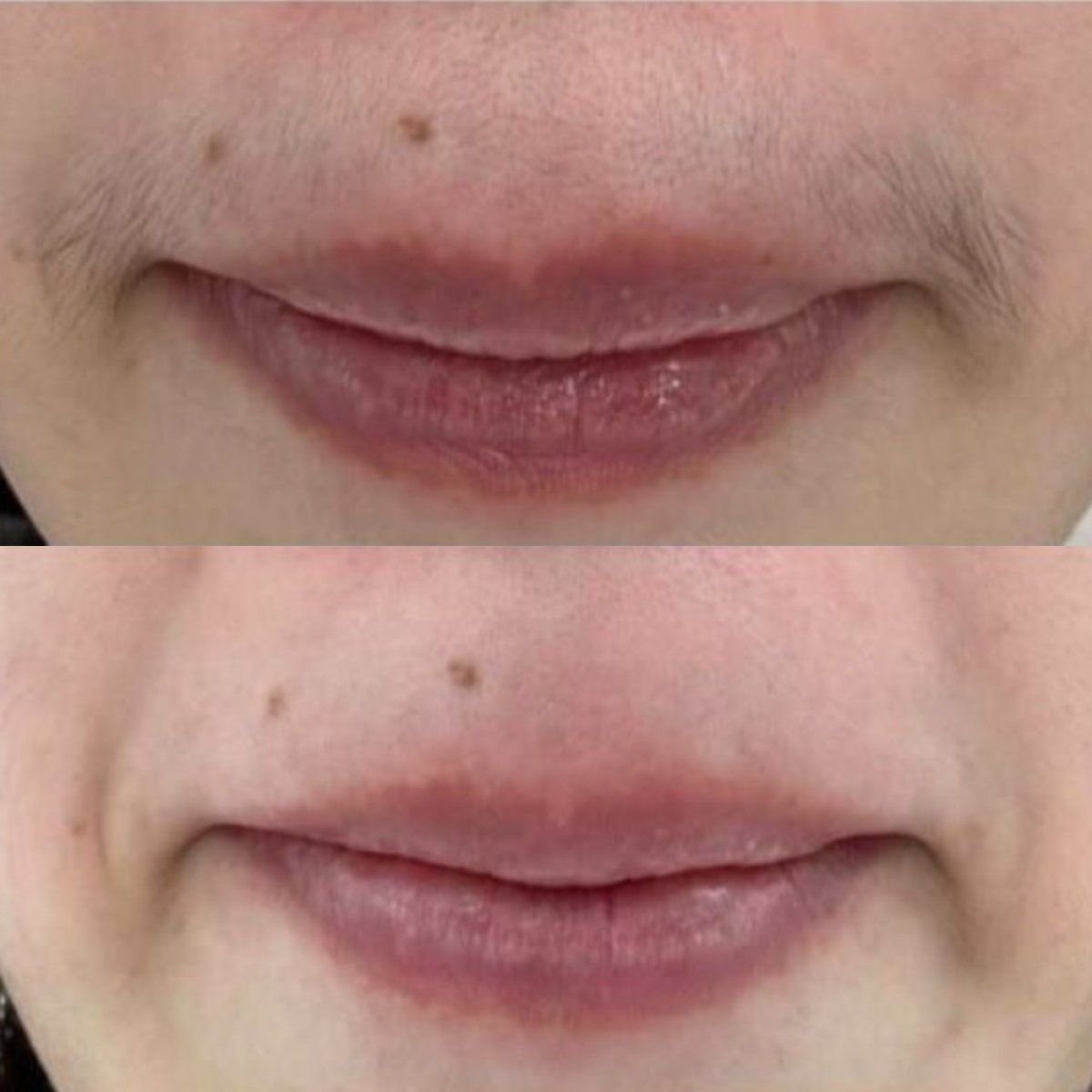 Resultados antes y después de depilación láser en labio superior en Wansiri Hospital
