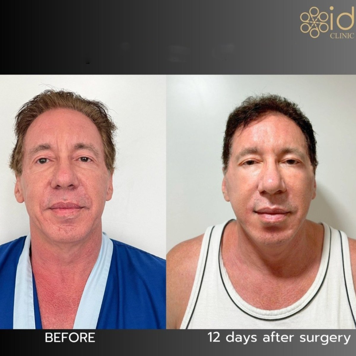 Before and after brow lift results at ID Clinic Bangkok, visible forehead and eye area improvement