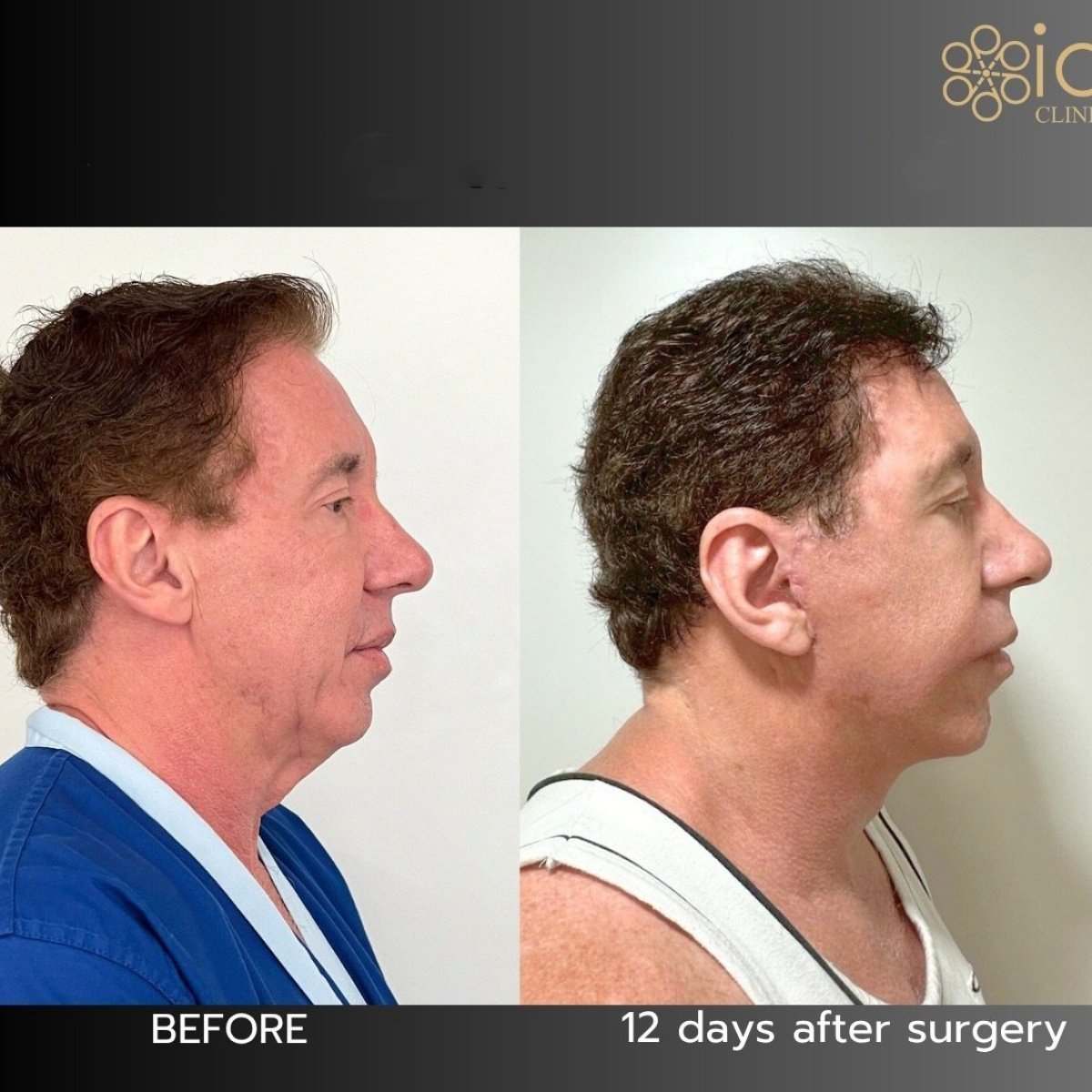 Before and after brow lift results at ID Clinic Bangkok, visible forehead and brow elevation