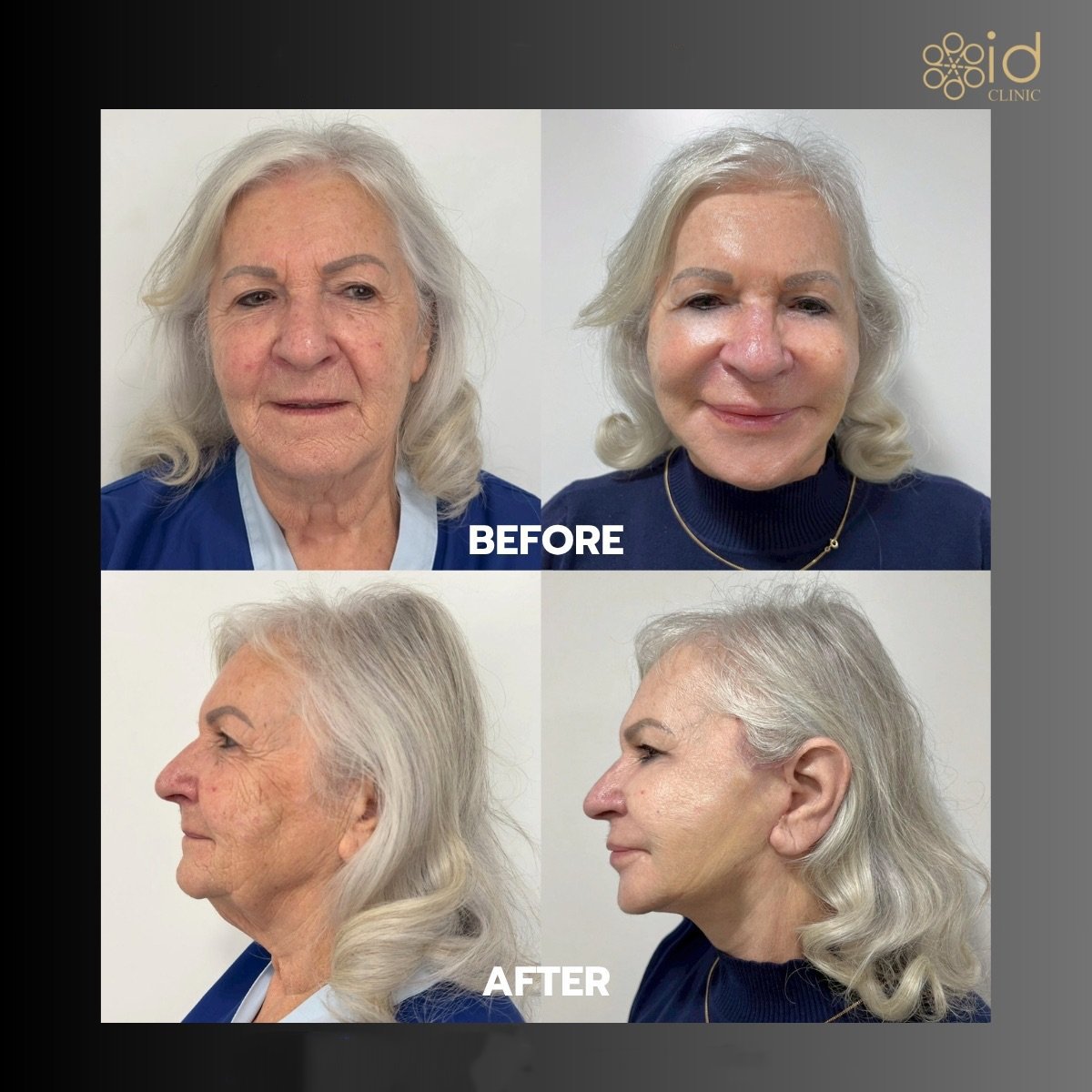 Before and after endoscopic facelift results at ID Clinic Bangkok, visible facial rejuvenation