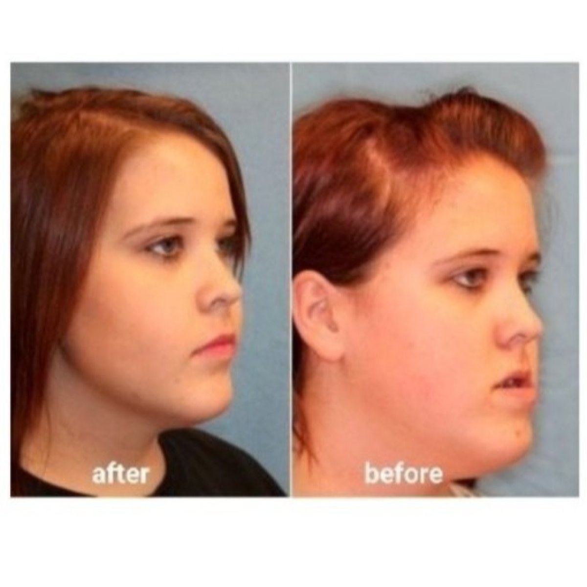 Before and after neck liposuction results at ID Clinic Bangkok, improved jawline contour
