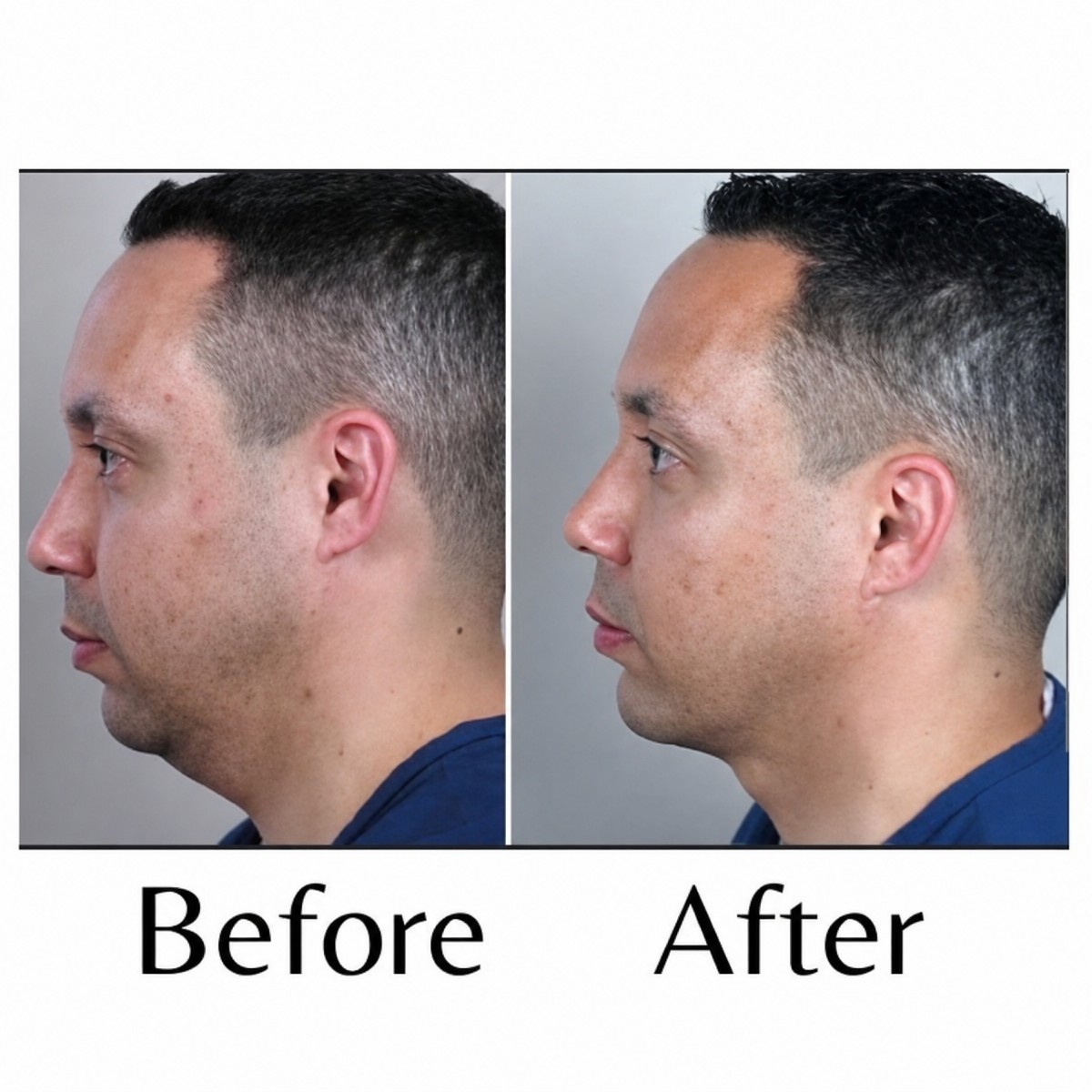 Before and after chin liposuction results at ID Clinic Bangkok, improved jawline contour