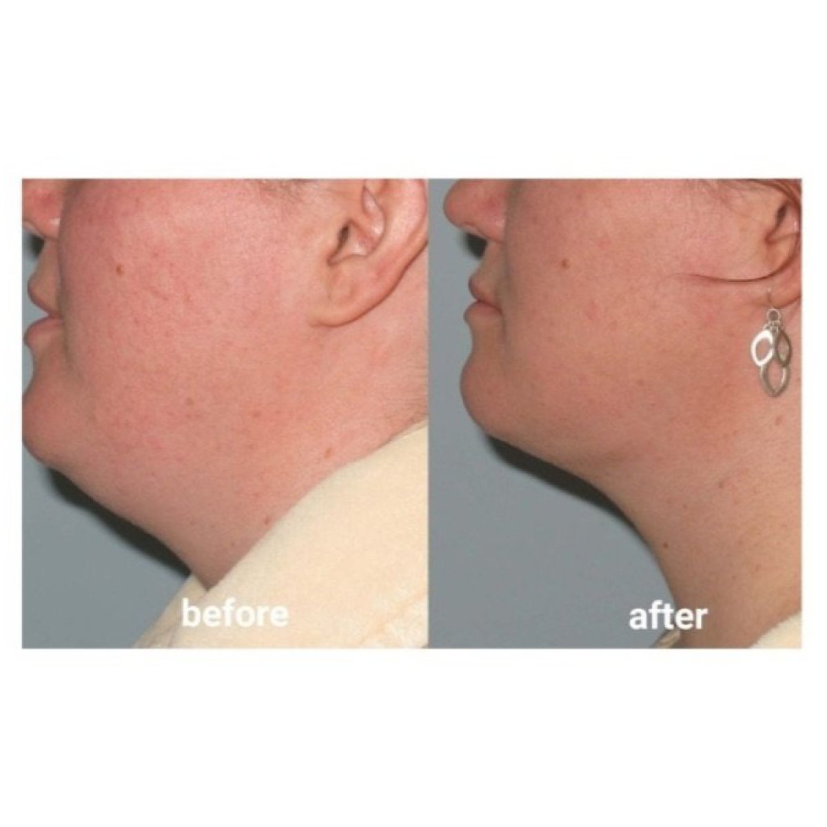 Résultats avant/après liposuccion du menton à ID Clinic Bangkok, contour amélioré