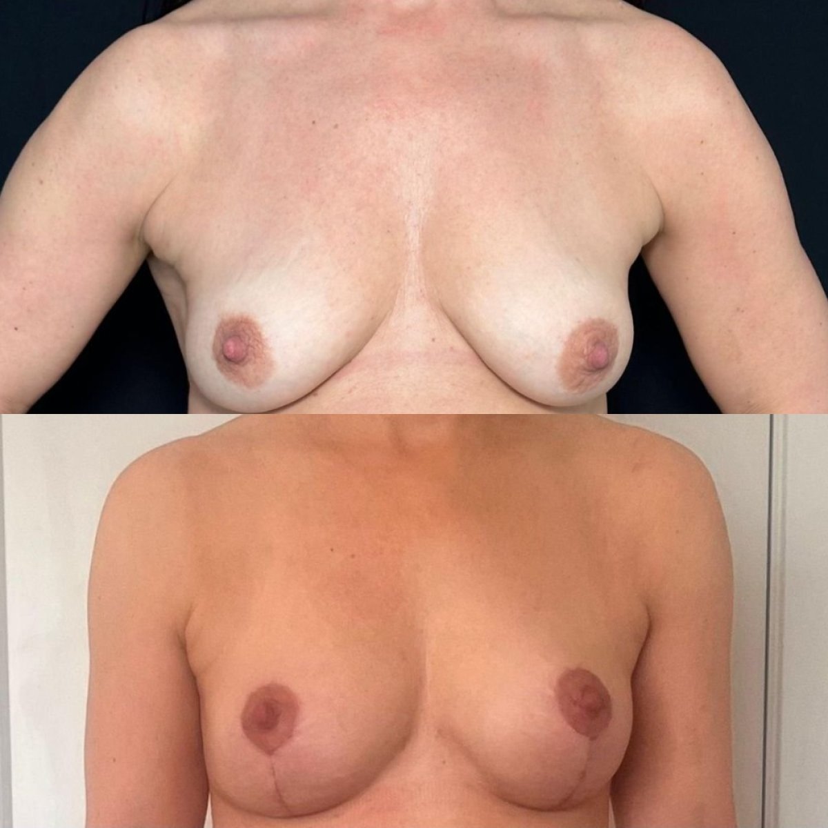 Antes y después de mastopexia con implantes redondos en Dr. Safa Manav Clinic, mejor contorno