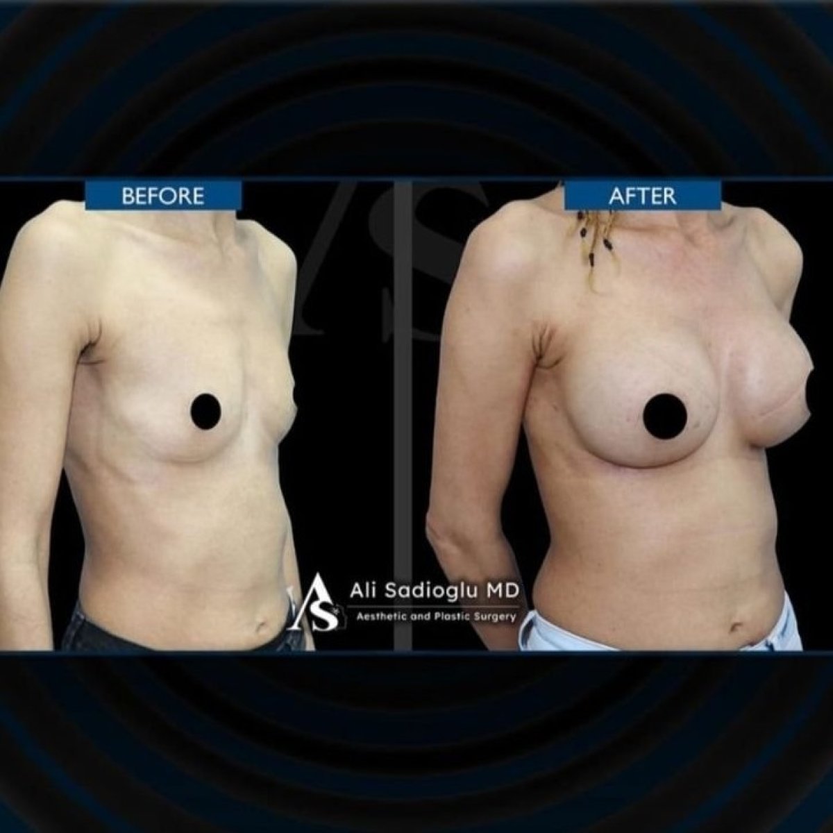 Resultados antes y después de mastopexia con implantes redondos en Dr. Safa Manav Clinic