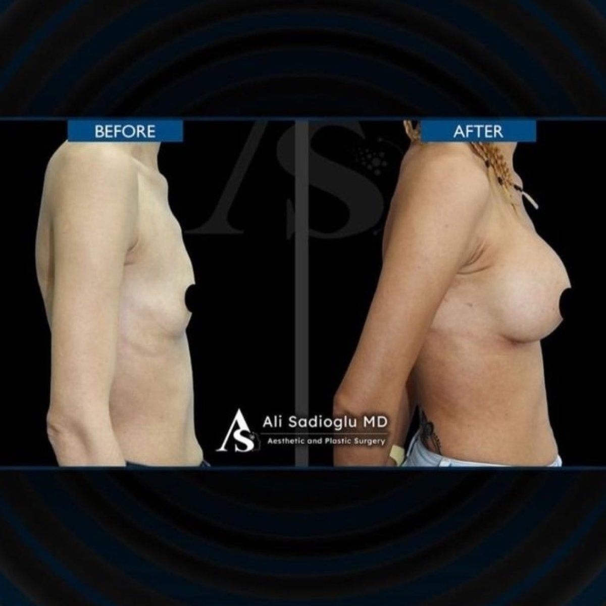 Résultats avant/après lifting mammaire avec implants ronds à la clinique Dr. Safa Manav