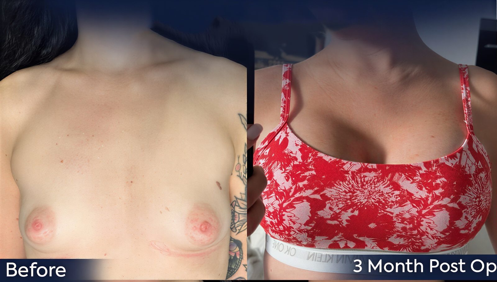 Antes y después de mastopexia con implantes redondos en Dr. Safa Manav Clinic, 3 meses