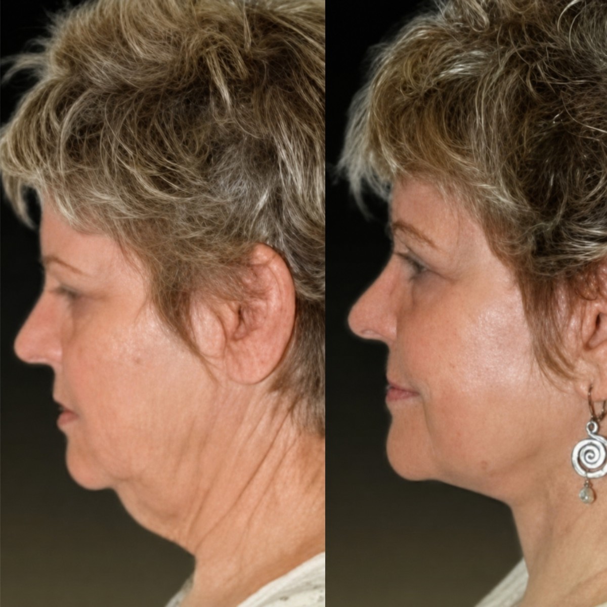 Resultados de lifting facial antes y después en Memorial Göztepe Hospital – mejora de la mandíbula