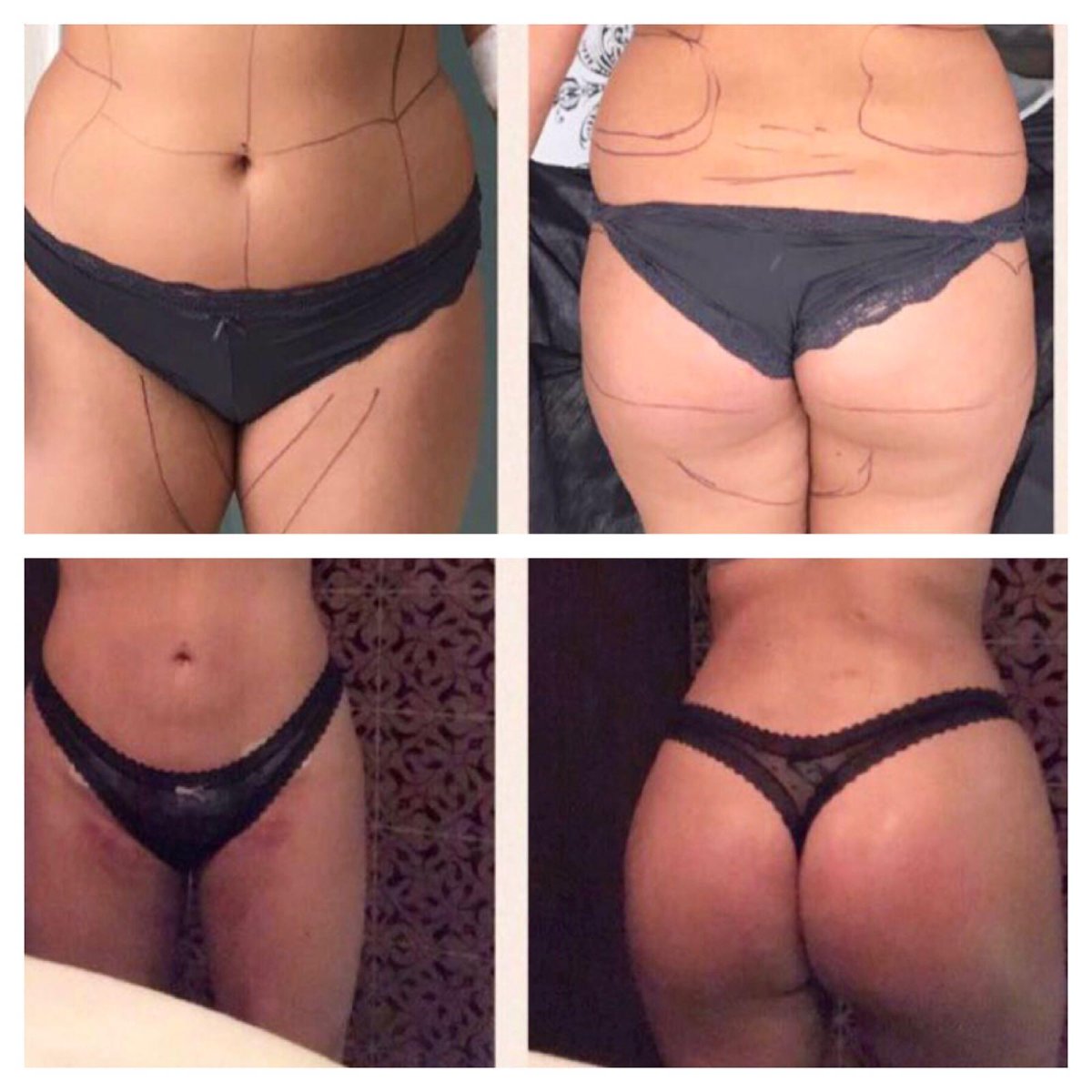 Результаты до и после Brazilian Butt Lift в Istanbul Aesthetic Plastic Surgery Center