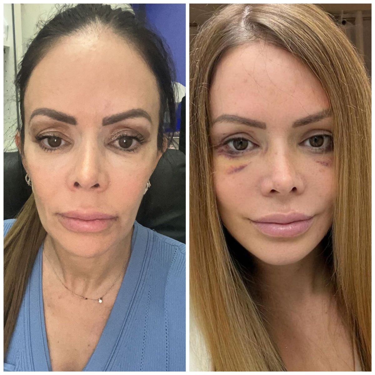 Resultados de rinoplastia antes y después en Istanbul Aesthetic Plastic Surgery Center, remodelación nasal