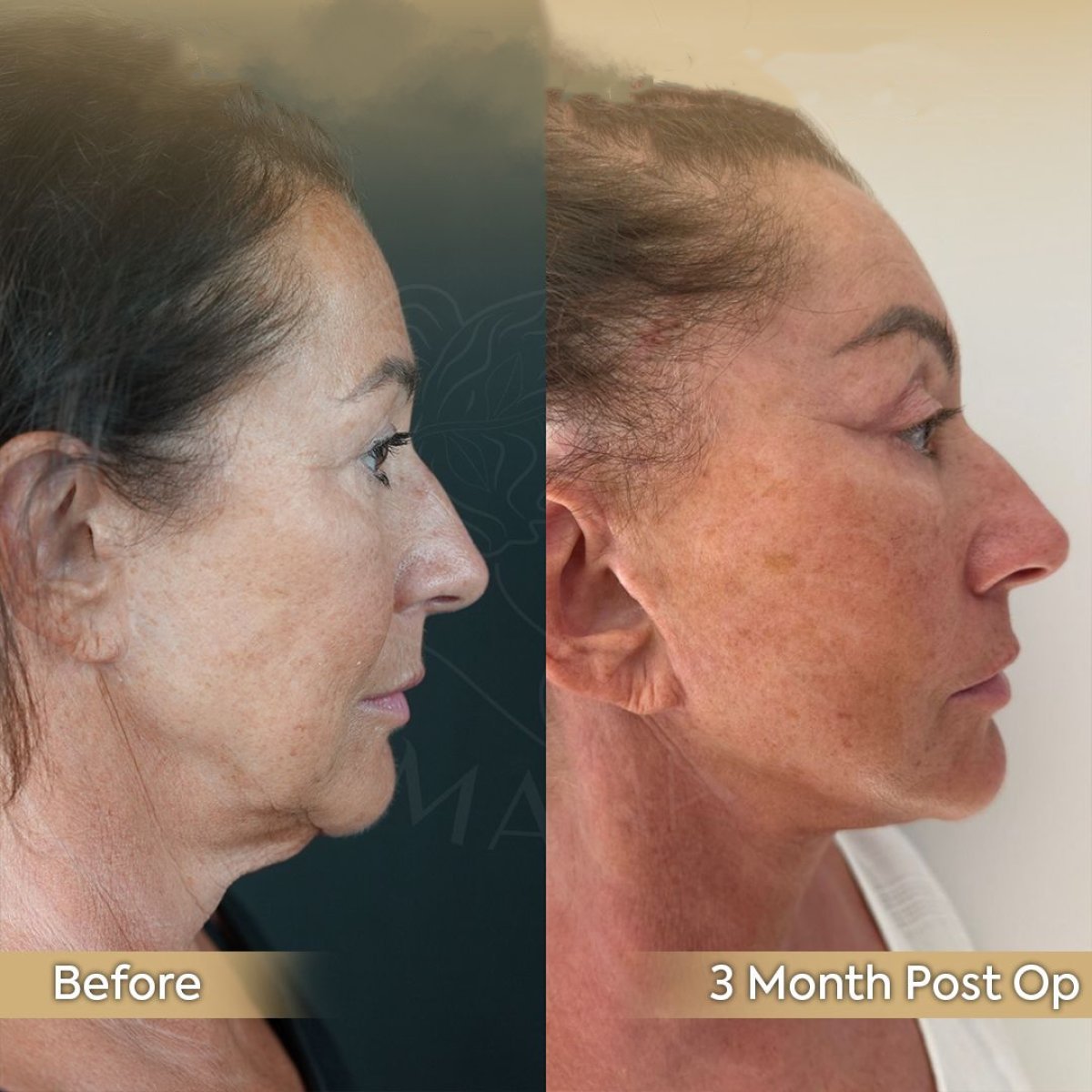 Resultados antes y después de lifting de cejas en Dr. Safa Manav Clinic, rejuvenecimiento facial
