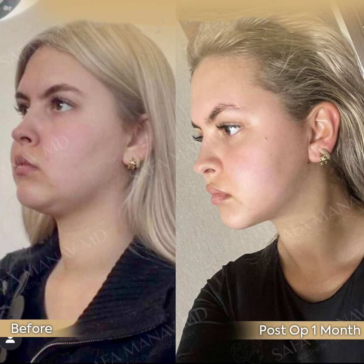 Before and after chin liposuction results at Dr. Safa Manav Clinic, improved jawline contour
