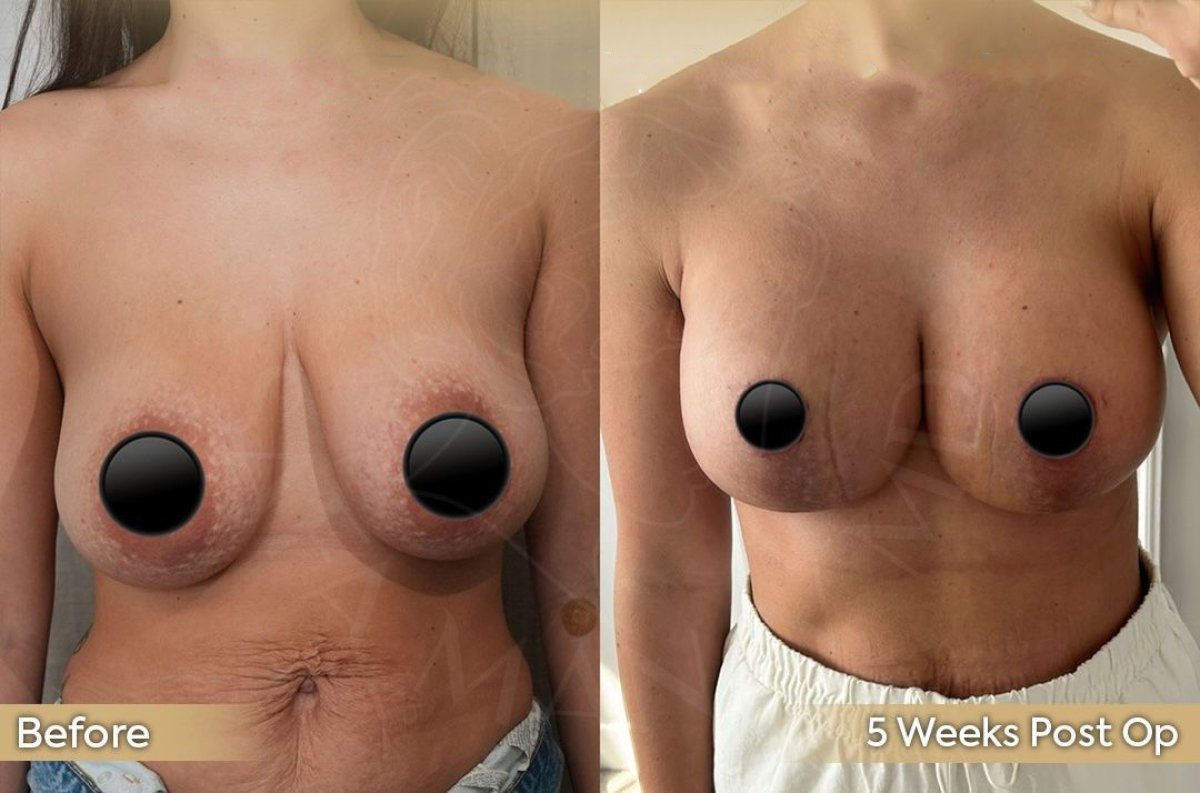 Before and after breast reduction results at Dr. Safa Manav Clinic, improved breast contour