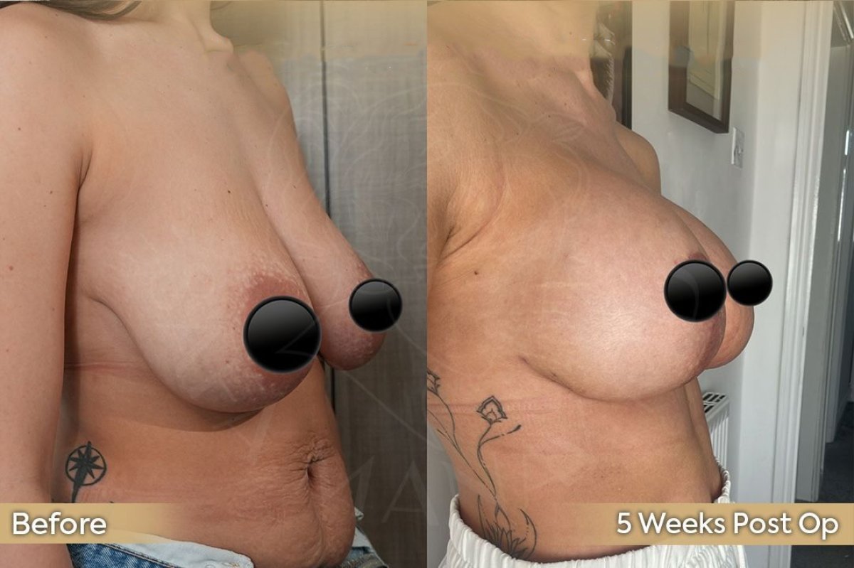 Resultados antes y después de reducción de pecho en Dr. Safa Manav Clinic, 5 semanas