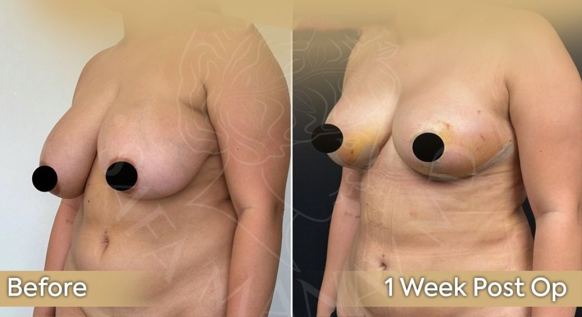 Resultados de reducción de senos antes y después en Dr. Safa Manav Clinic, 1 semana