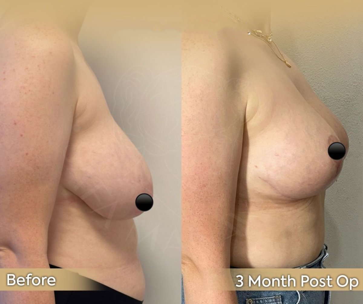 Resultados de reducción de senos antes y después en Dr. Safa Manav Clinic, 3 meses