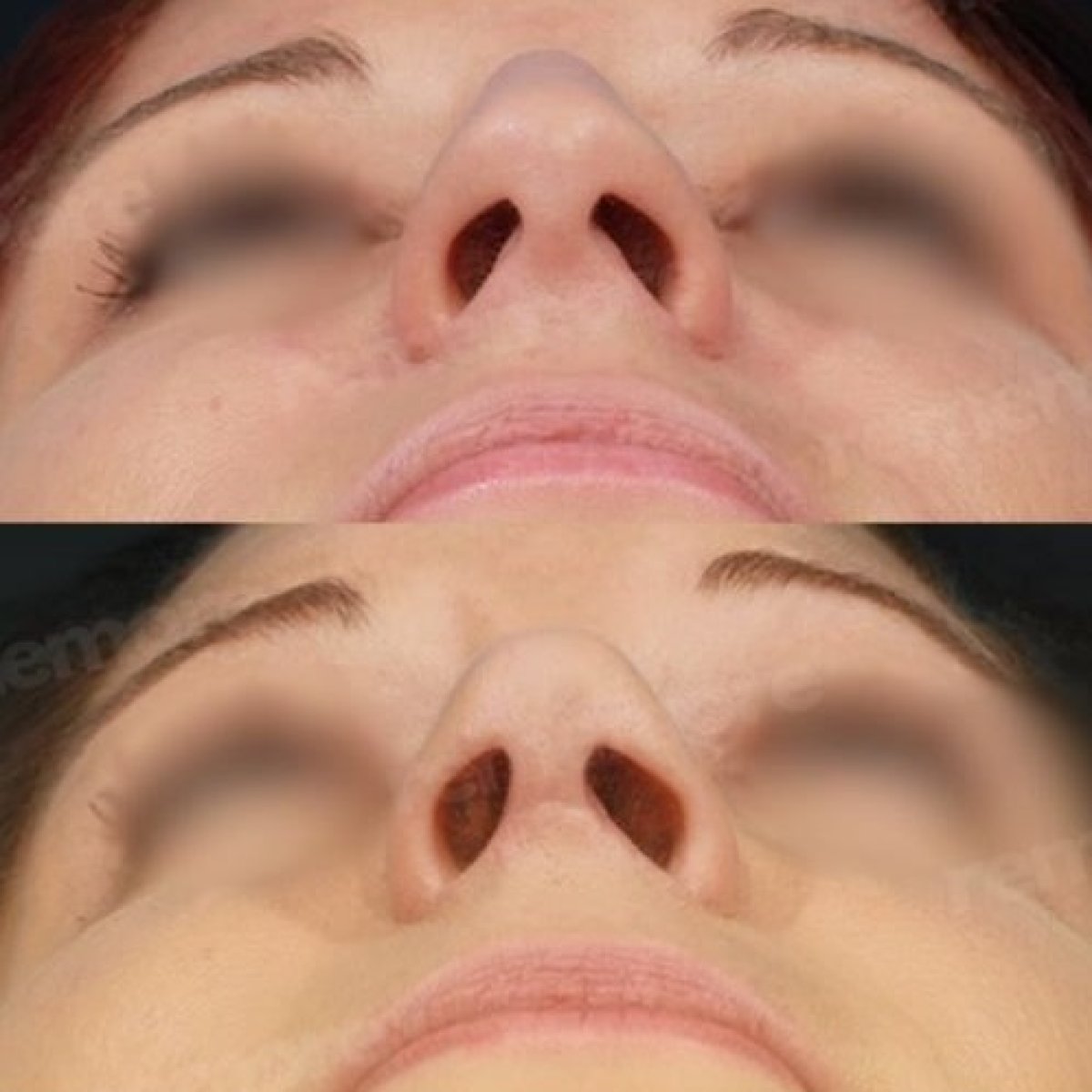 نتائج عملية تجميل الأنف قبل وبعد في مستشفى ميموريال غوزتيبي، تحسين شكل الأنف