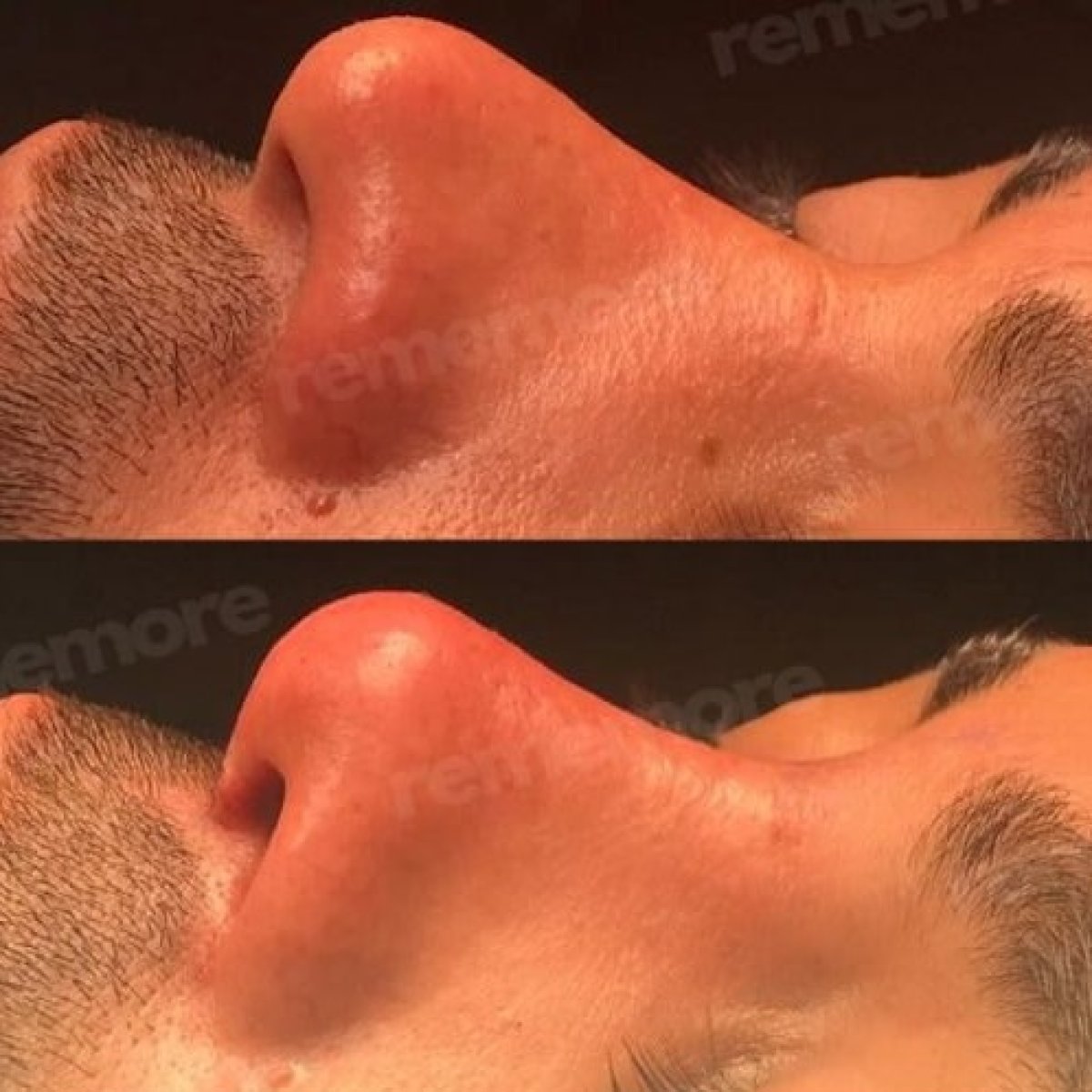 نتائج عملية تجميل الأنف قبل وبعد في مستشفى ميموريال غوزتيبي، تحسين شكل الأنف