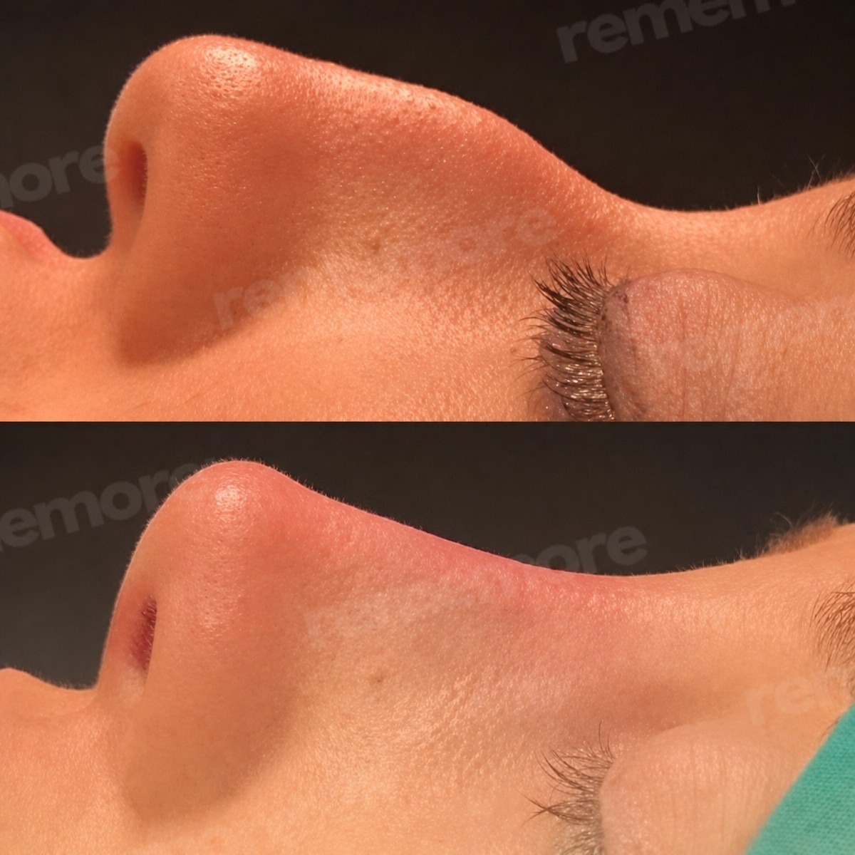 Before and after rhinoplasty results at Memorial Göztepe Hospital, improved nose profile