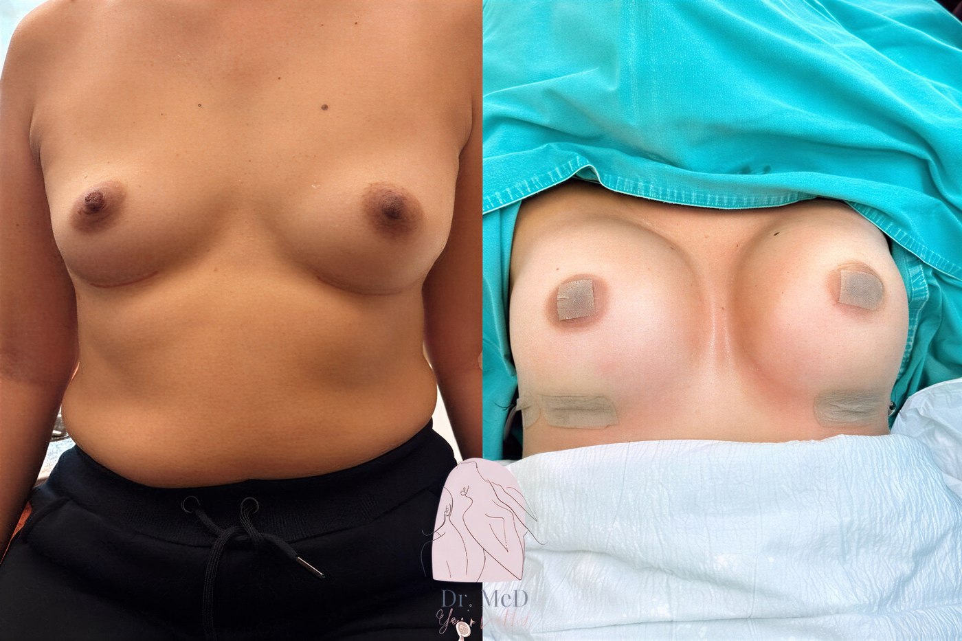 Resultados antes y después de aumento de senos con lipofilling en Dr. MED