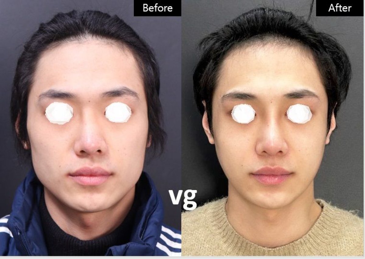 Before and after cheekbone reduction results at VG Plastic Surgery, facial contour improvement