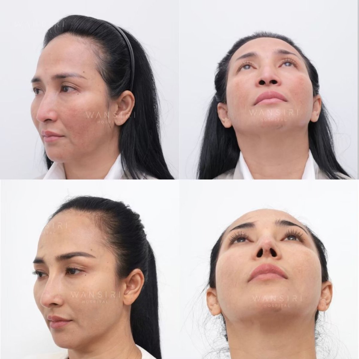 نتائج قبل وبعد عملية تجميل الأنف التصحيحية في مستشفى وانسيري، تحسين شكل الأنف