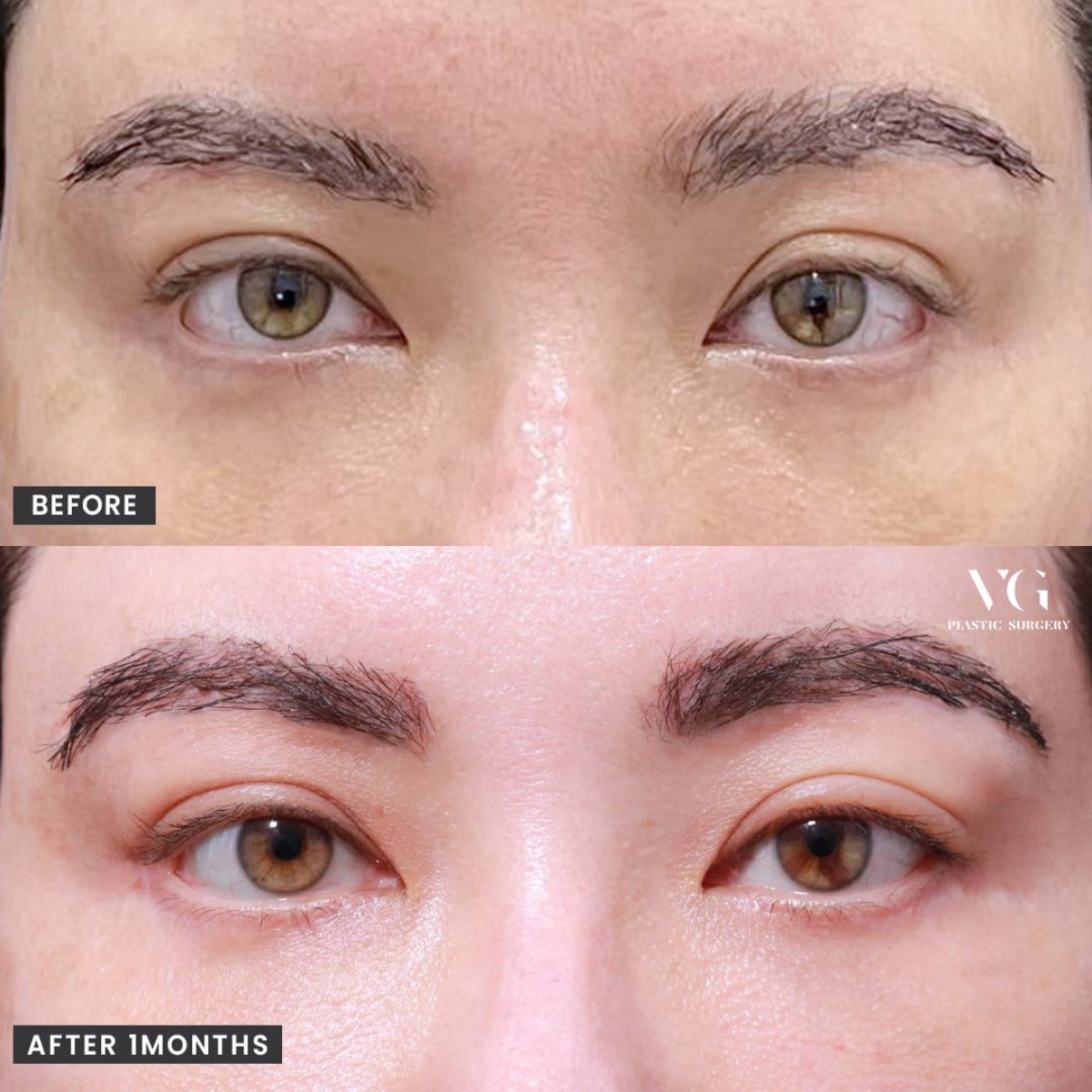 Результати кантопластики (cat eye surgery) до і після у клініці VG Plastic Surgery