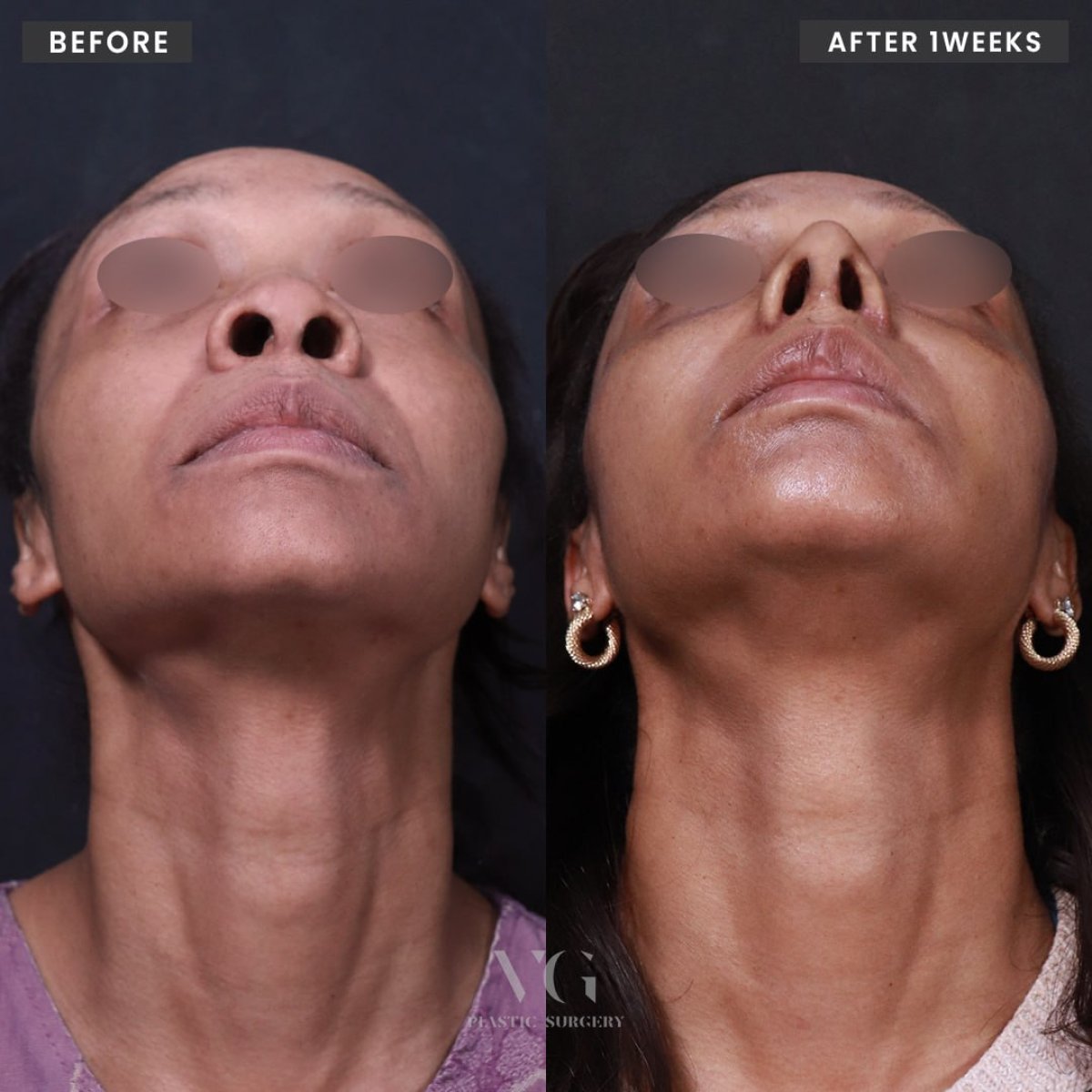 Resultados de rinoplastia étnica antes y después en VG Plastic Surgery, mejora visible de la nariz