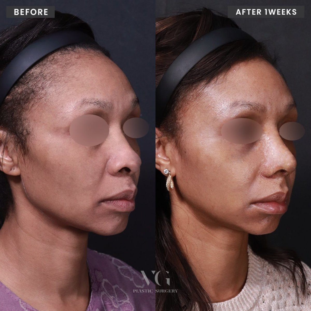 Résultats avant et après rhinoplastie ethnique chez VG Plastic Surgery, amélioration du nez