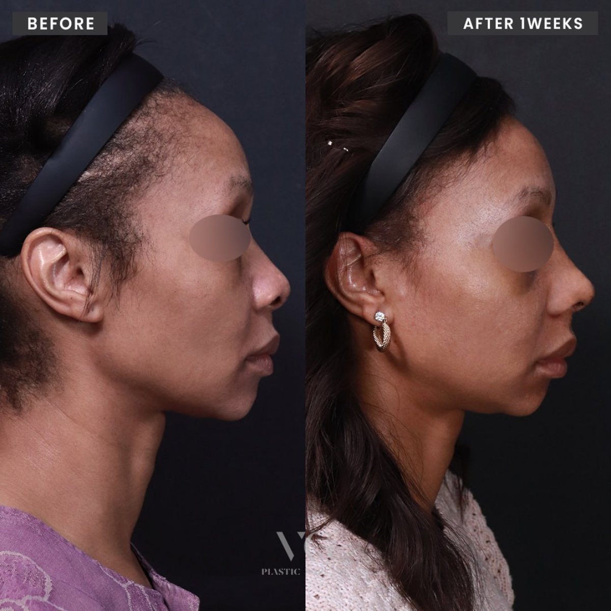 Résultats avant/après rhinoplastie ethnique chez VG Plastic Surgery, profil du nez amélioré