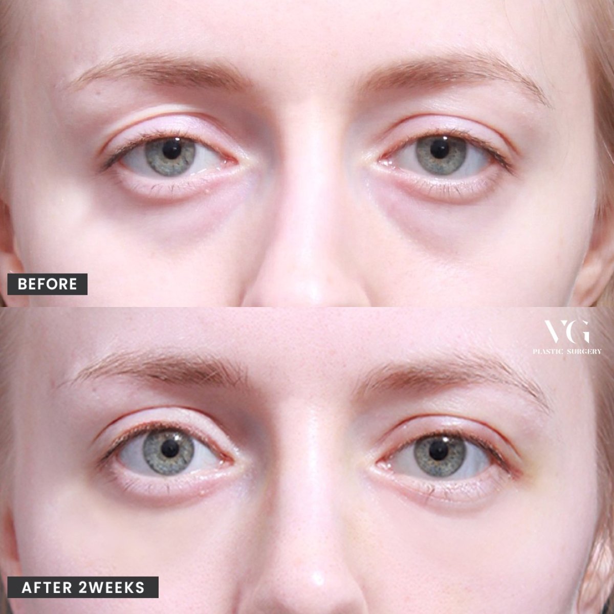 Lower eyelid blepharoplasty before and after results at VG Plastic Surgery, reduced eye bags