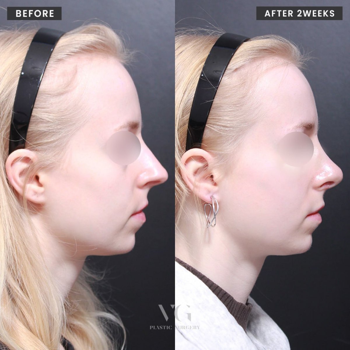 Resultados de rinoplastia antes y después en VG Plastic Surgery, remodelación nasal tras 2 semanas