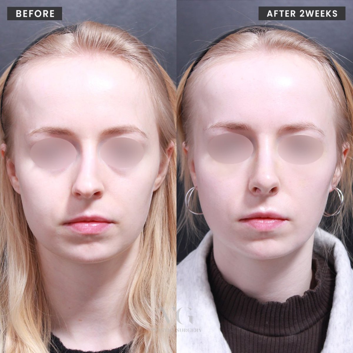 Antes y después de rinoplastia en VG Plastic Surgery, resultados tras 2 semanas