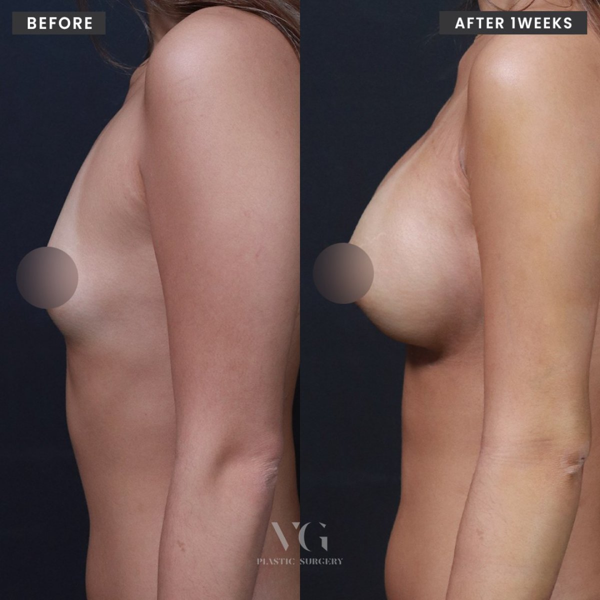 Resultados de aumento de senos antes y después en VG Plastic Surgery, mayor volumen mamario