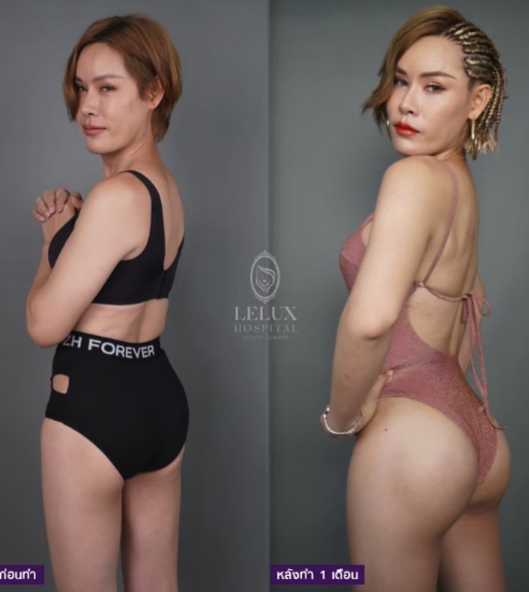 Before and after buttock augmentation results at Lelux Hospital – enhanced body contour