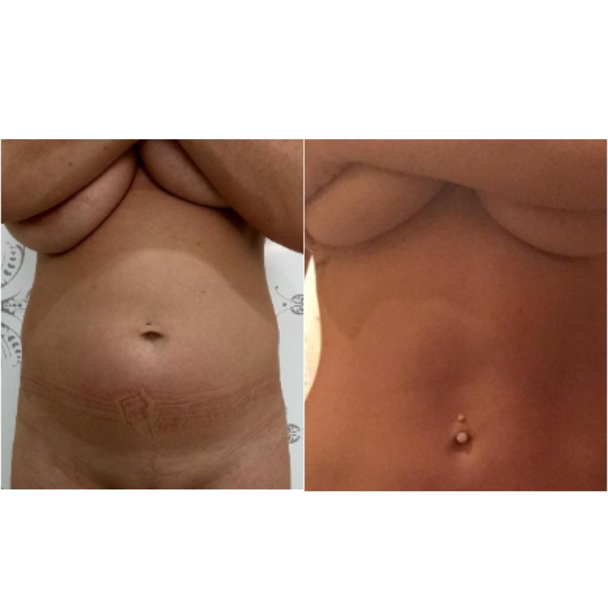نتائج شفط الدهون قبل وبعد في مركز اسطنبول لجراحة التجميل، بطن مسطح