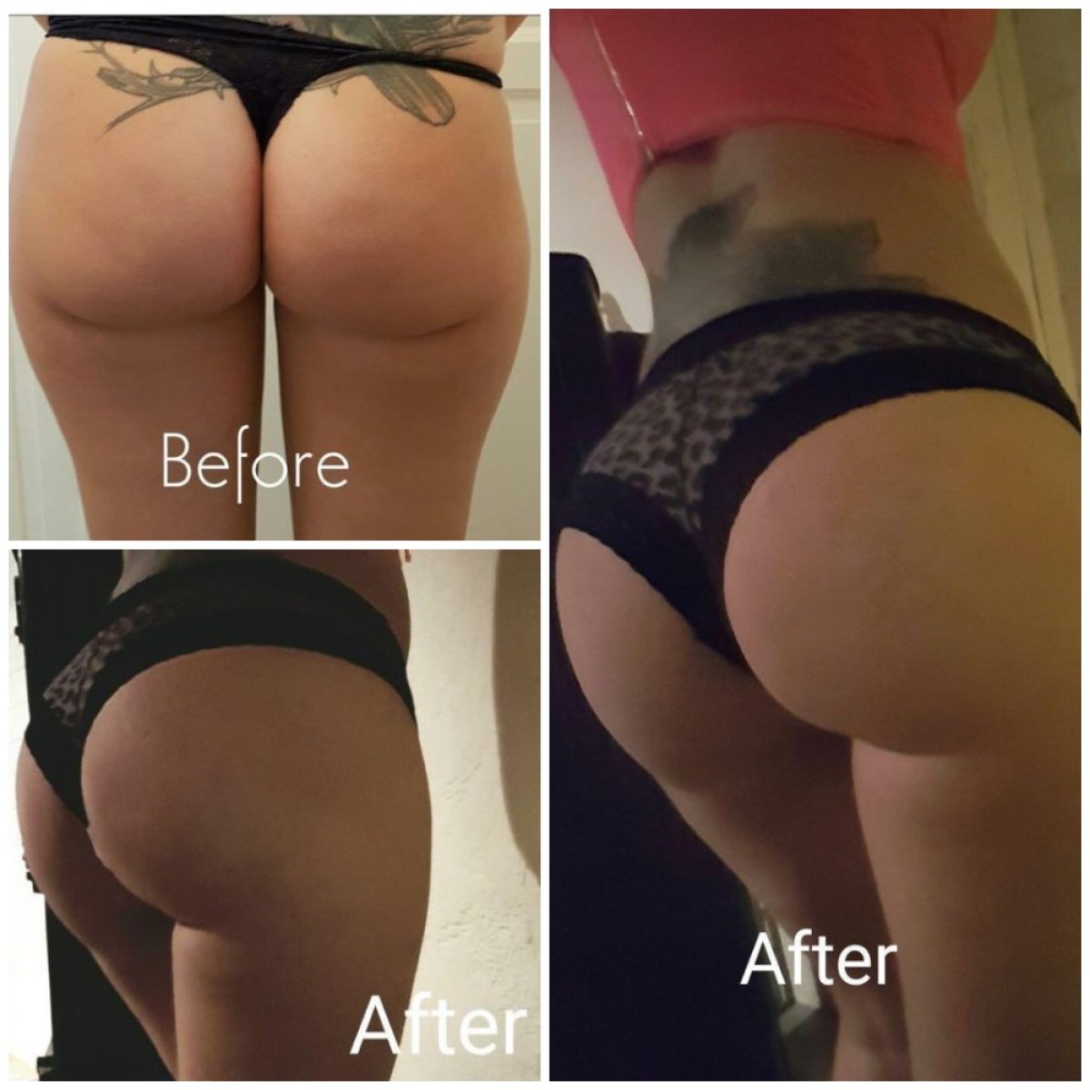 نتائج قبل وبعد عملية Brazilian Butt Lift في Istanbul Aesthetic Plastic Surgery Center