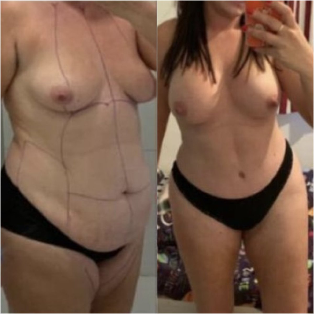 Результаты до и после маммопластики в Istanbul Aesthetic Plastic Surgery Center, коррекция тела