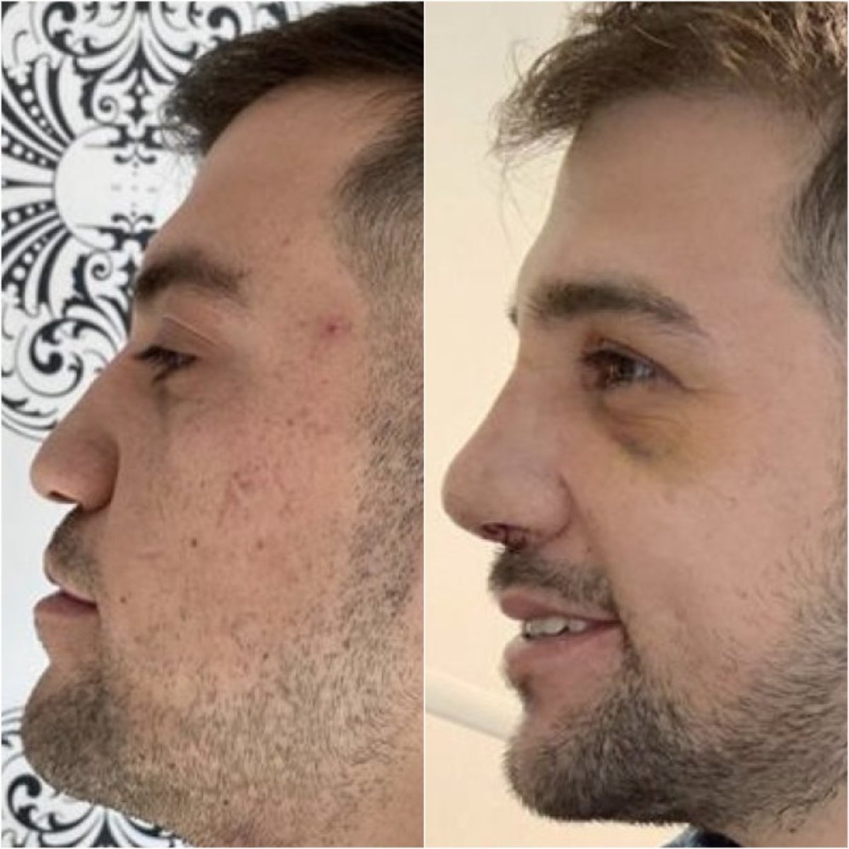 Before and after male rhinoplasty result at Istanbul Aesthetic Plastic Surgery Center