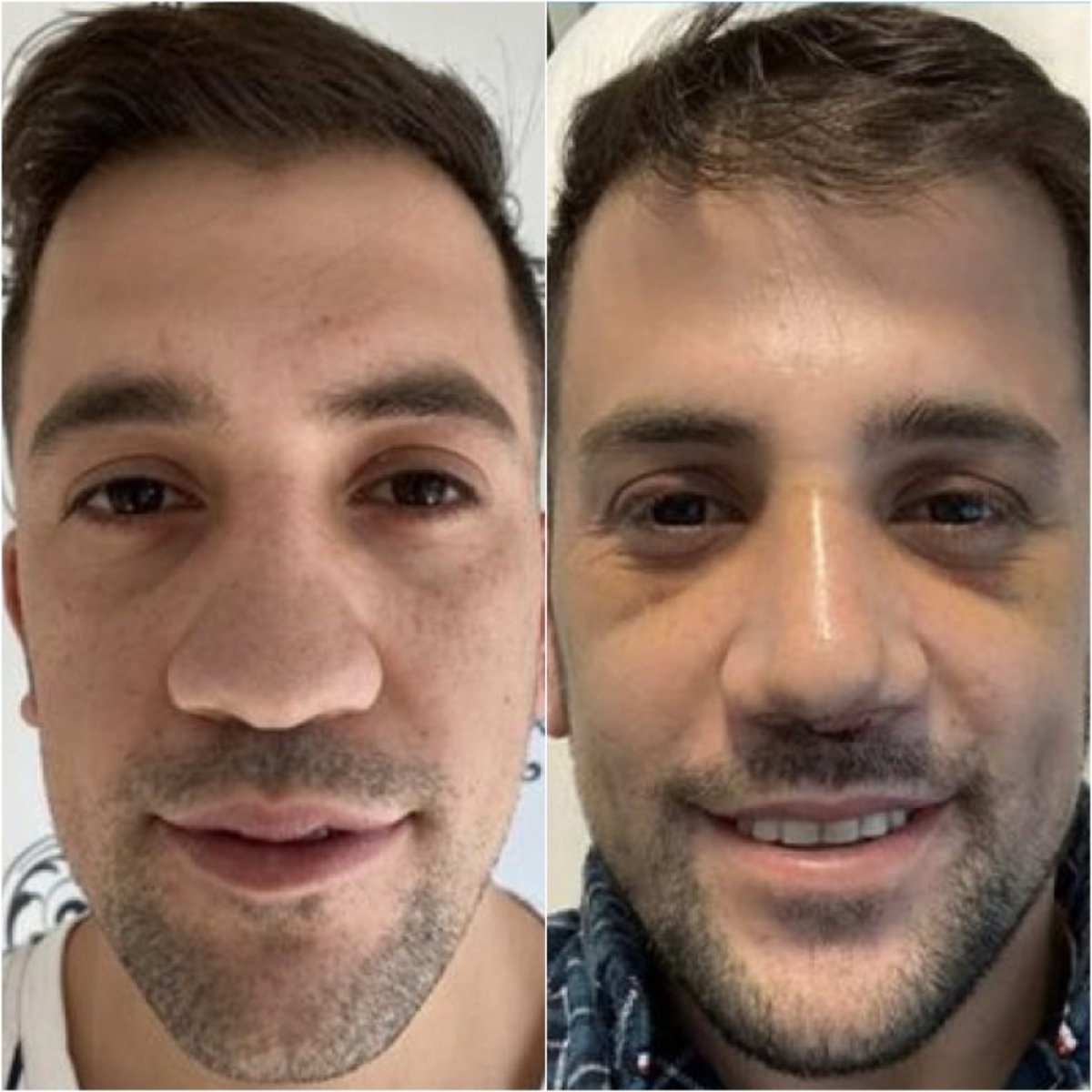 Before and after male rhinoplasty results at Istanbul Aesthetic Plastic Surgery Center