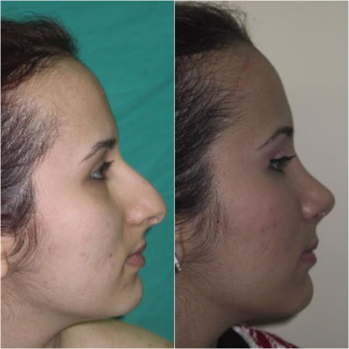 نتائج تجميل الأنف قبل وبعد في مركز اسطنبول لجراحة التجميل، إعادة تشكيل الأنف