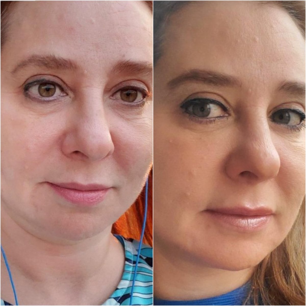 نتائج عملية تجميل الأنف قبل وبعد في Istanbul Aesthetic Plastic Surgery Center، شكل أنف محسّن
