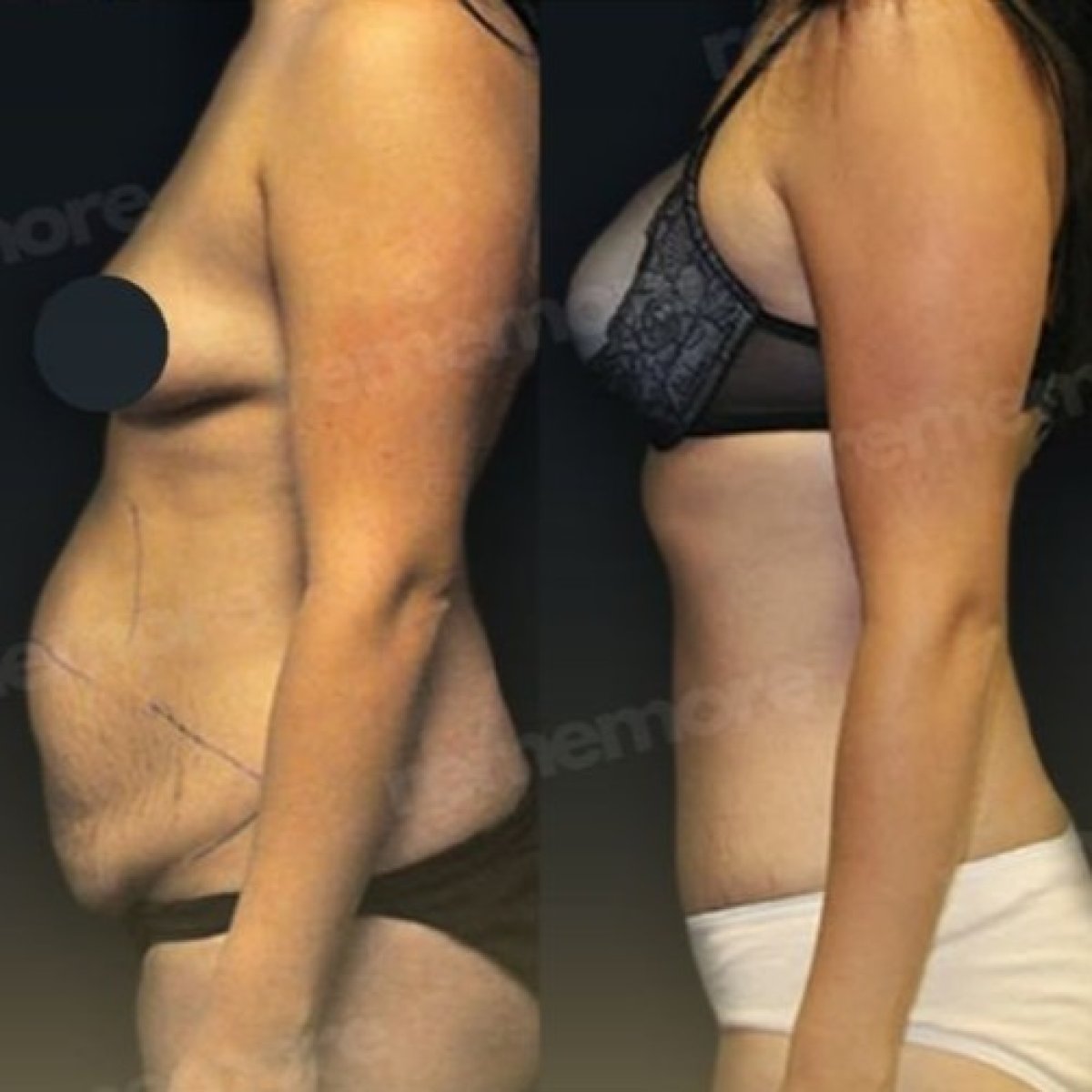 Résultats avant/après abdominoplastie et liposuccion à Memorial Bahçelievler Hospital