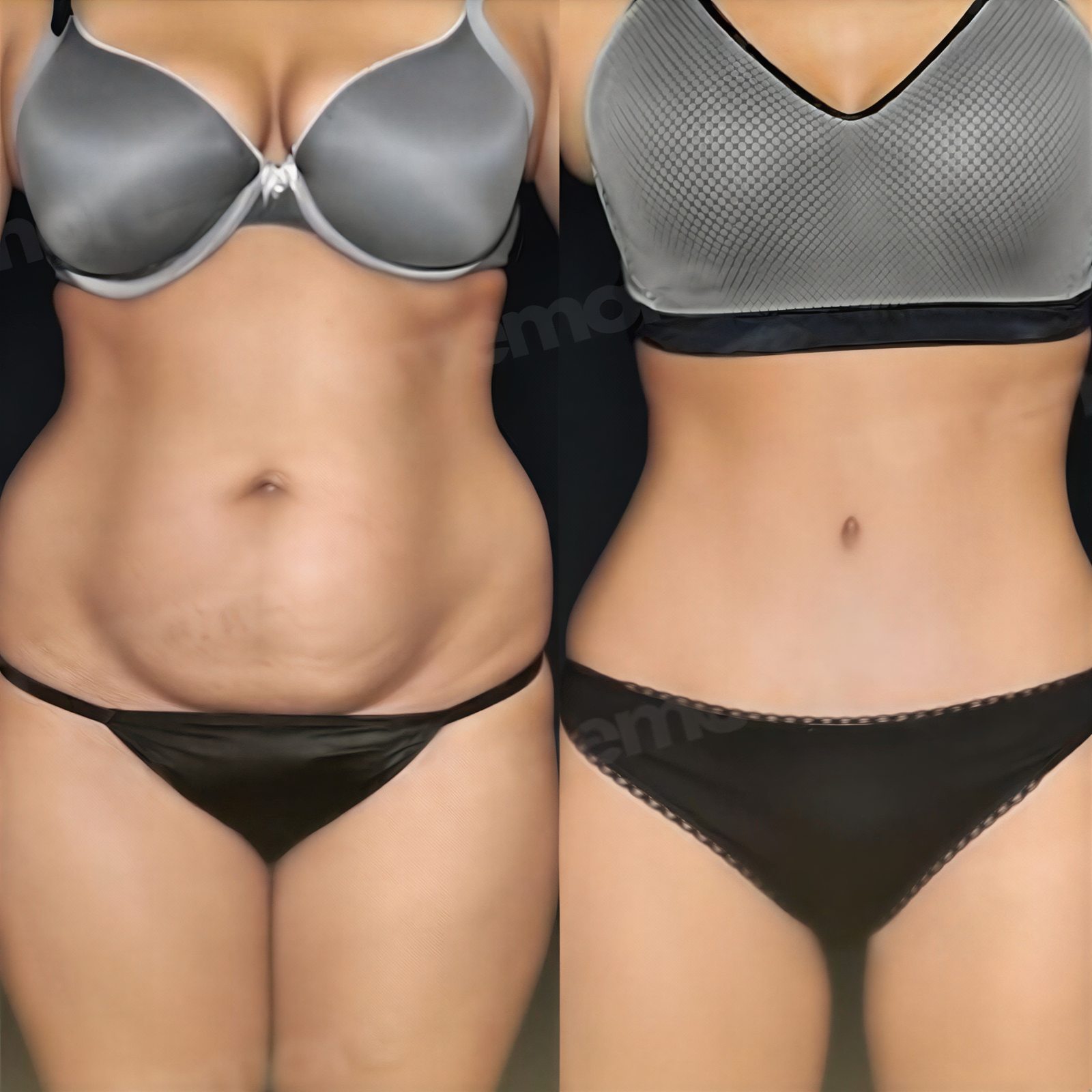 Resultados antes y después de abdominoplastia y liposucción en Memorial Bahçelievler Hospital