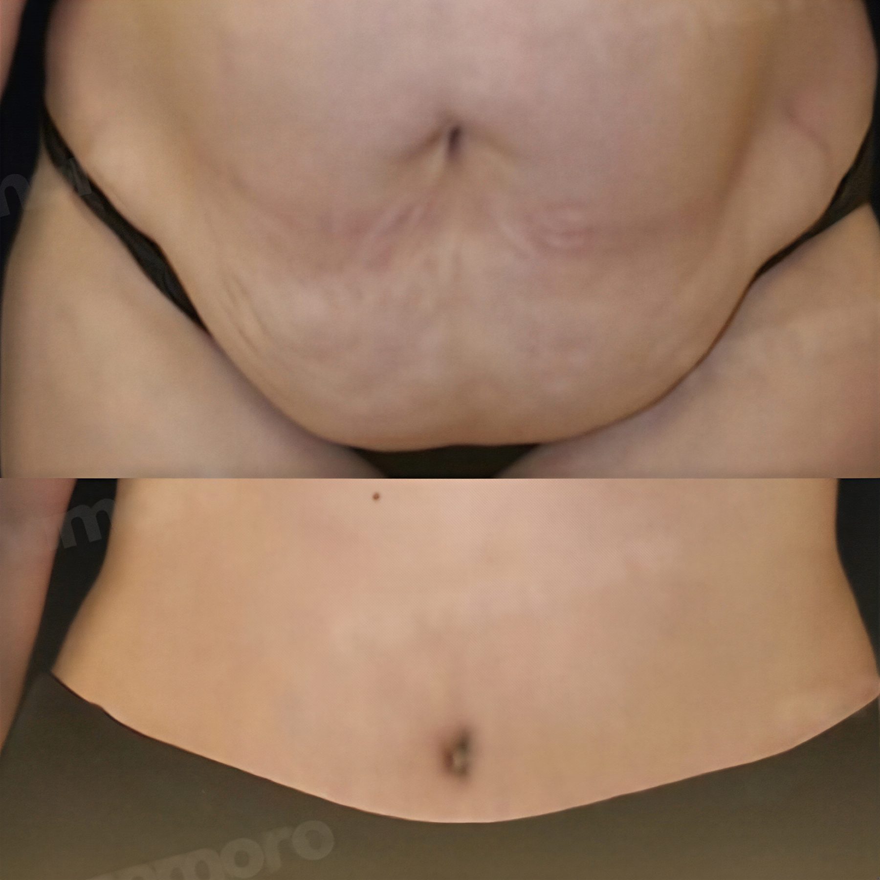 Resultados antes y después de abdominoplastia y liposucción en Memorial Bahçelievler Hospital