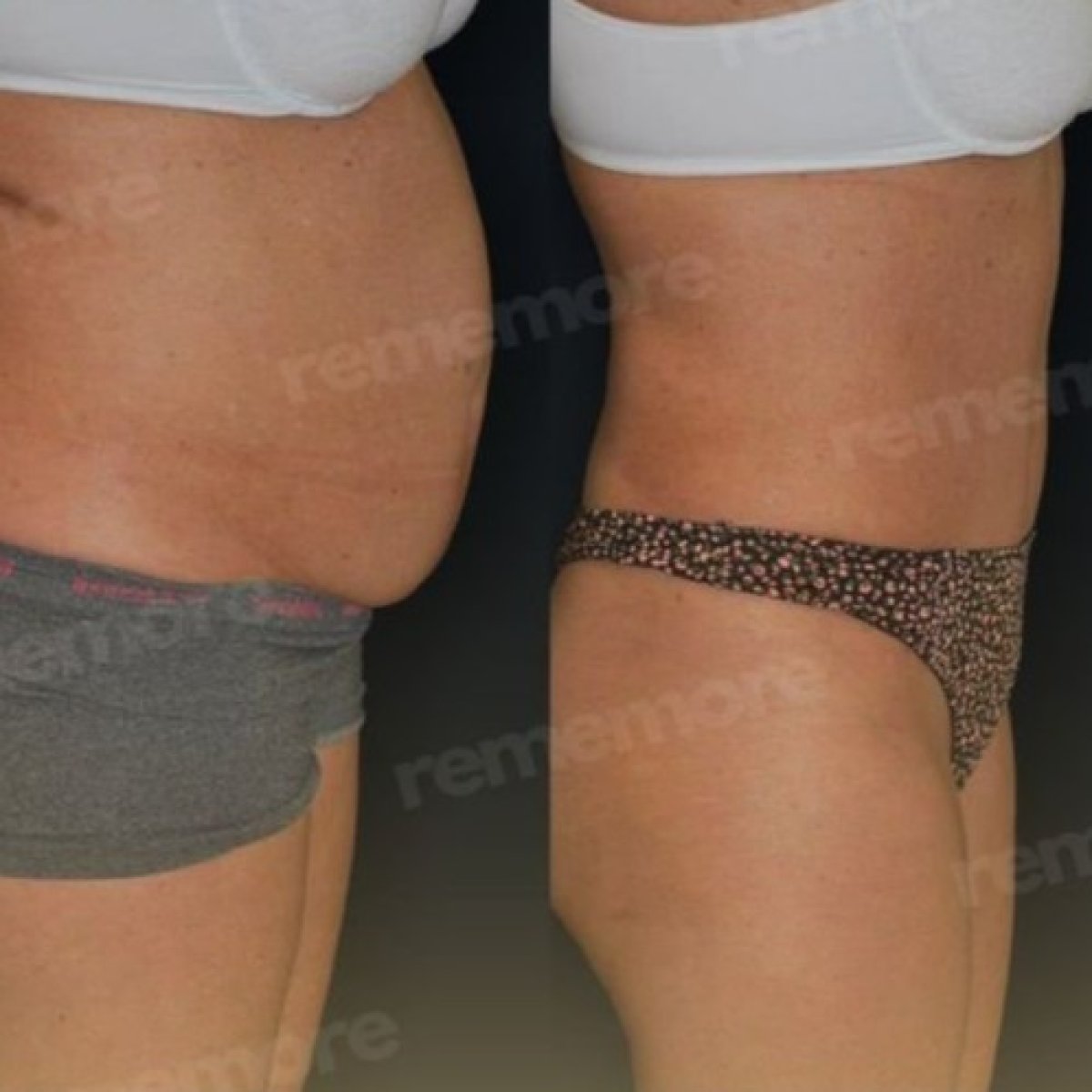 Before and after liposuction results at Memorial Şişli Hospital, improved abdominal contour