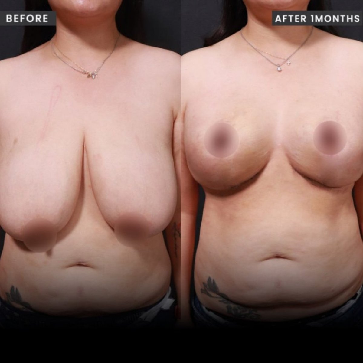 Before and after breast lift results at VG Plastic Surgery, improved breast contour visible