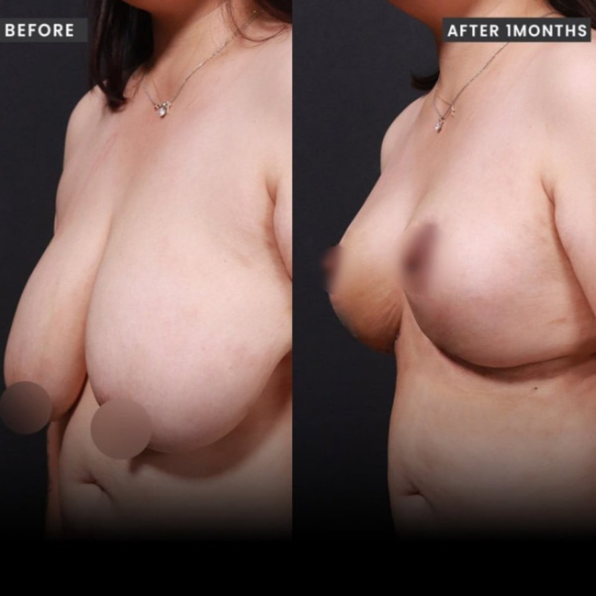 نتائج شد الثدي قبل وبعد في VG Plastic Surgery، تحسين شكل الثدي بشكل واضح