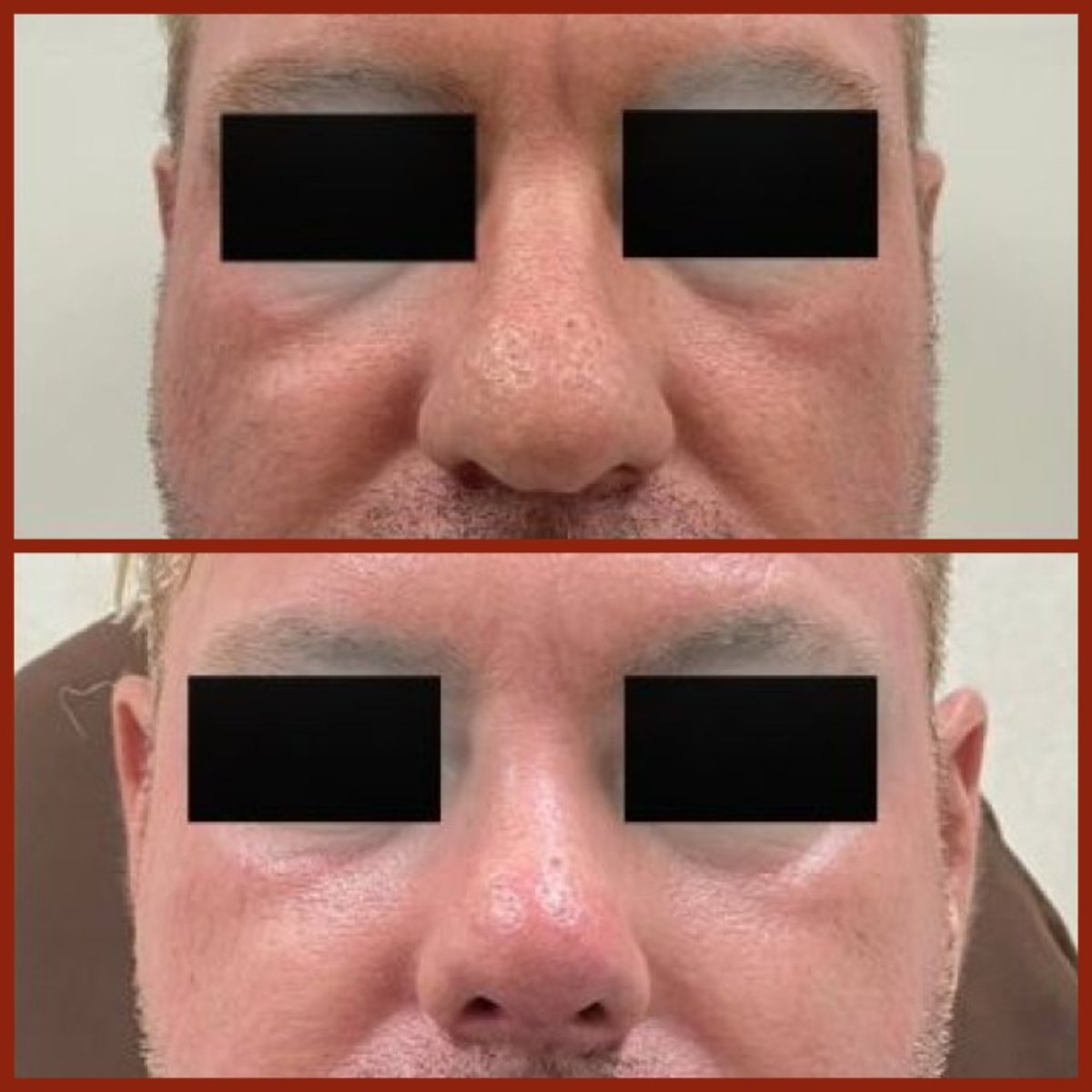 Resultados de rinoplastia antes y después en DGB Clinic, mejora de forma y simetría nasal